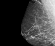 X-ray image of a breast