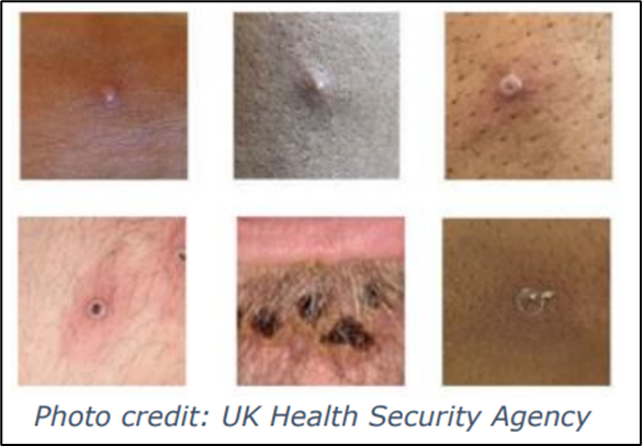 Mpox rash on different skin tones