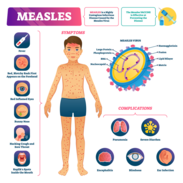 measles