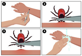 Tick removal