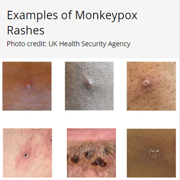 monkeypox_image