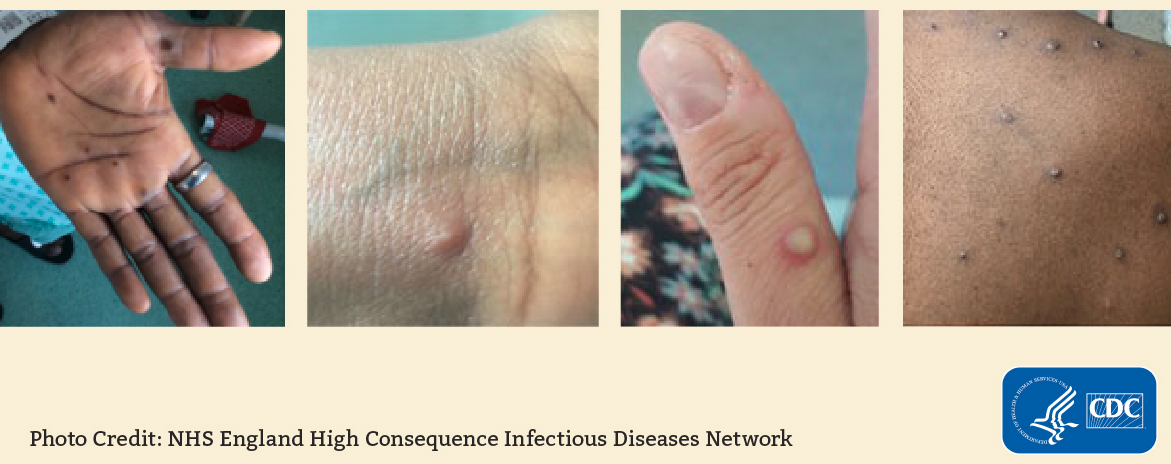 image of monkeypox rash