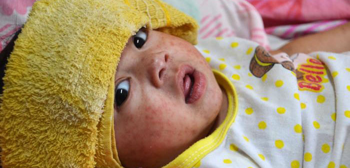 child with measles rash 