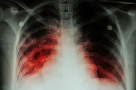 X-ray film shows pulmonary tuberculosis or TB.