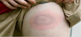 lyme disease 
